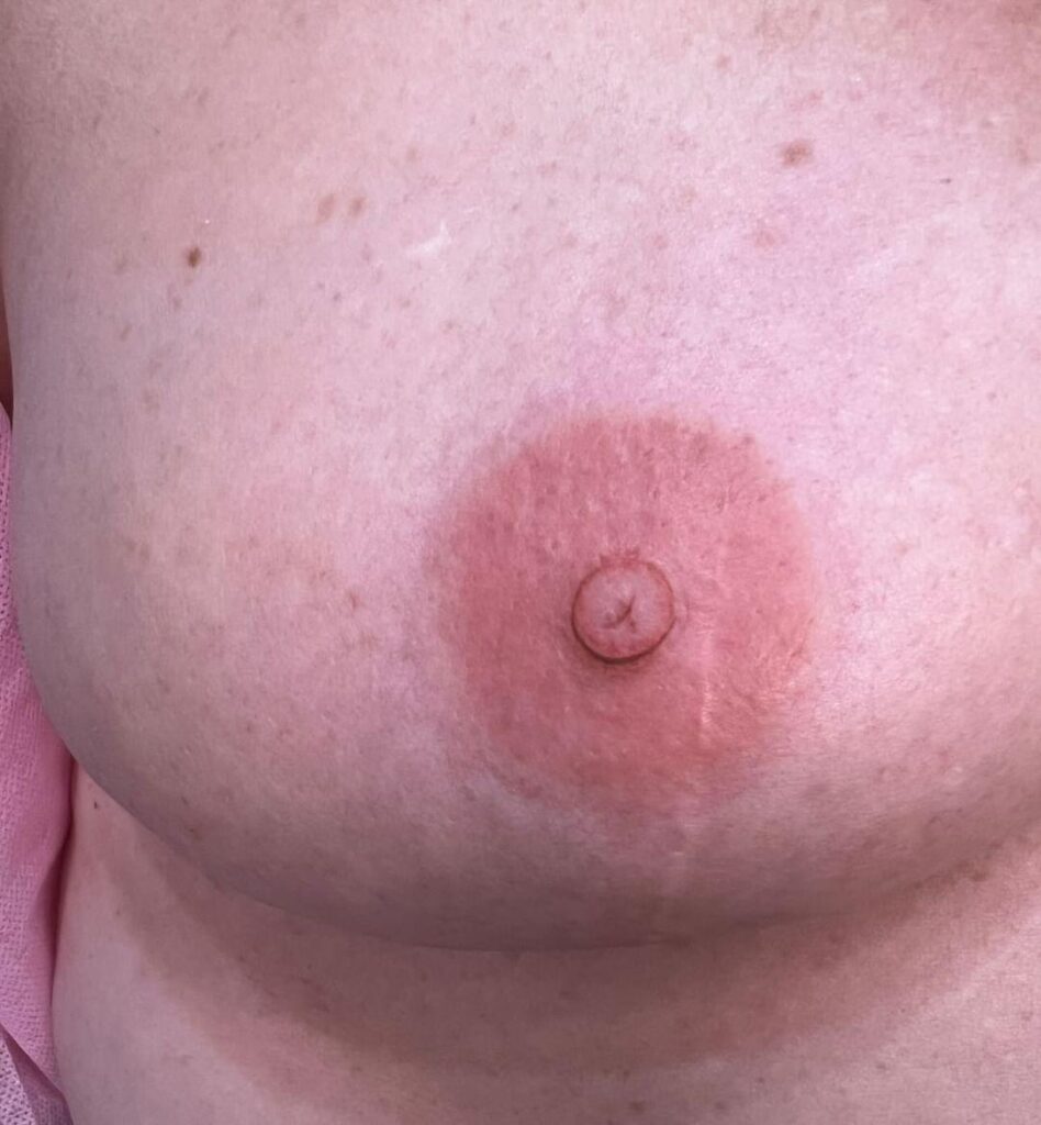 Paramedical areola tattooing for breast cancer survivors